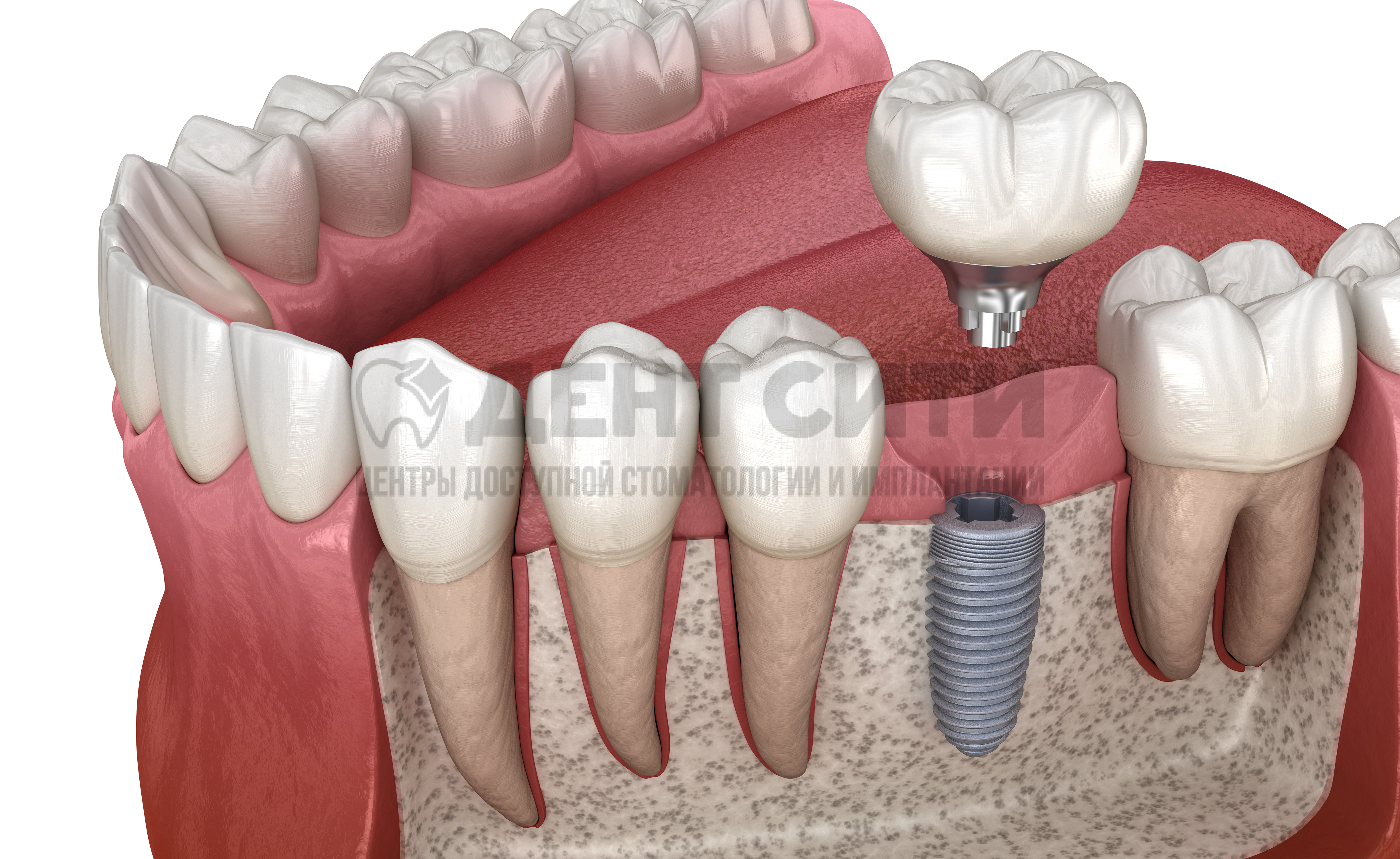 Имплантация зубов и системы All-on-4,  All-on-6