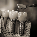 виды зубных имплантов: какой выбрать?