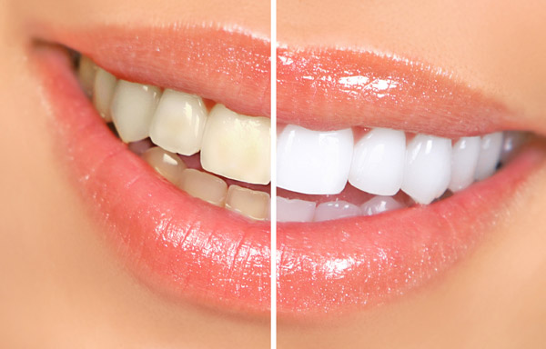 преимущества отбеливания зубов в стоматологической клинике