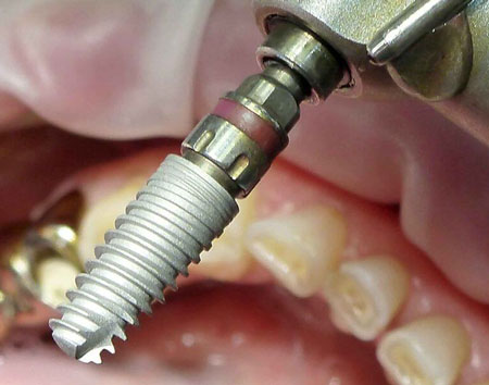 основные причины отторжения зубных имплантов