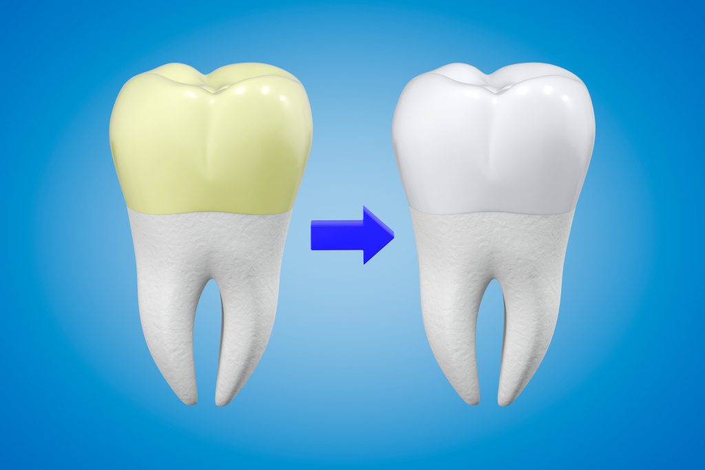 что такое зубной налет?