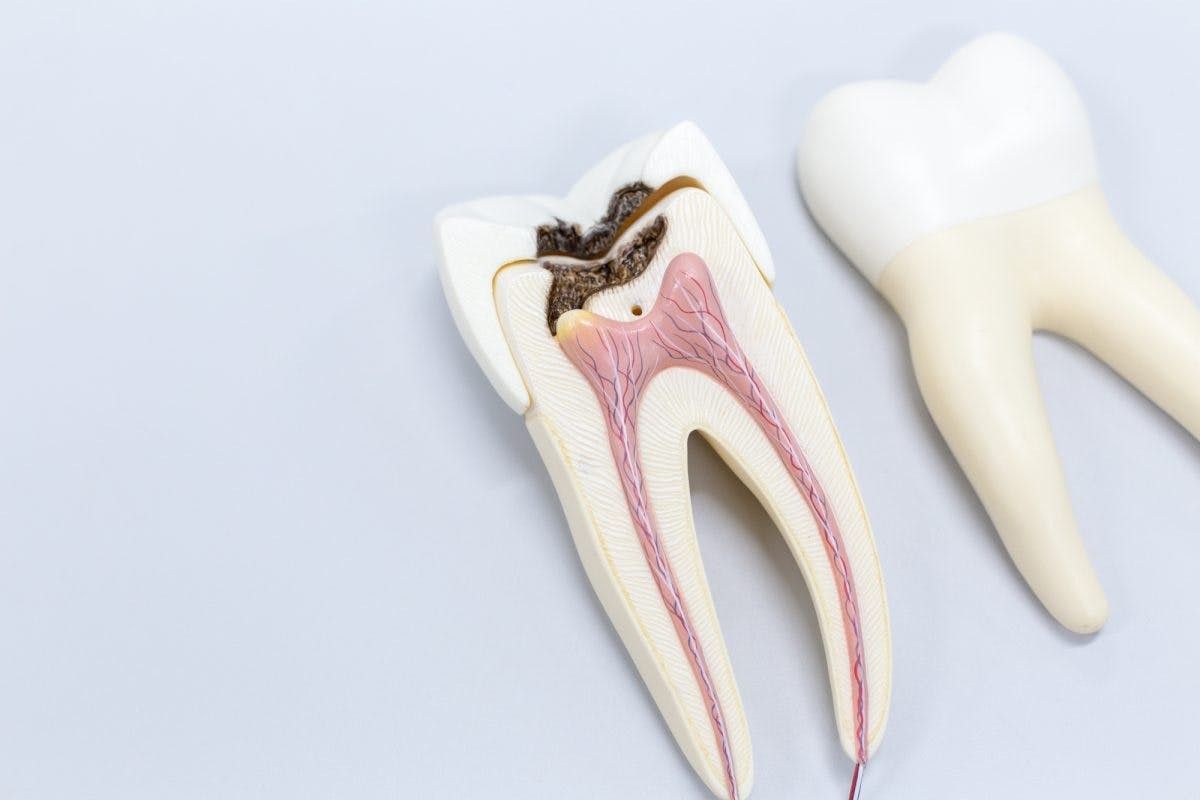пульпит: ваше здоровье зубов в приоритете