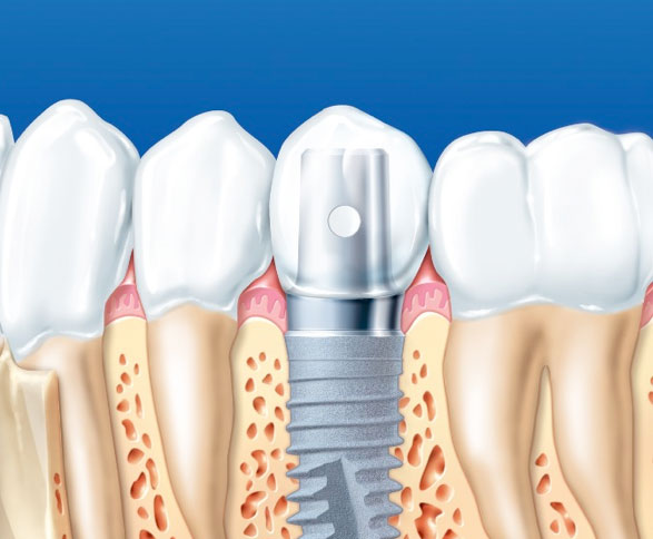 как ставятся зубные импланты?