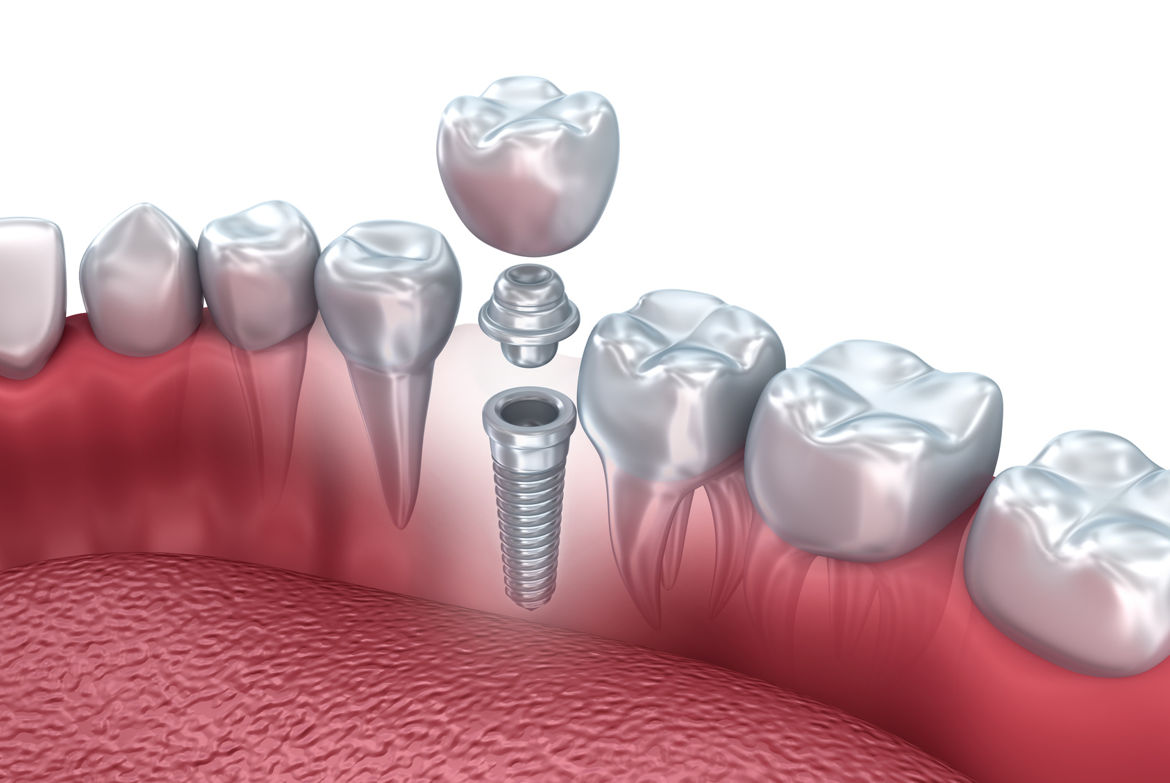из чего делают зубные импланты?