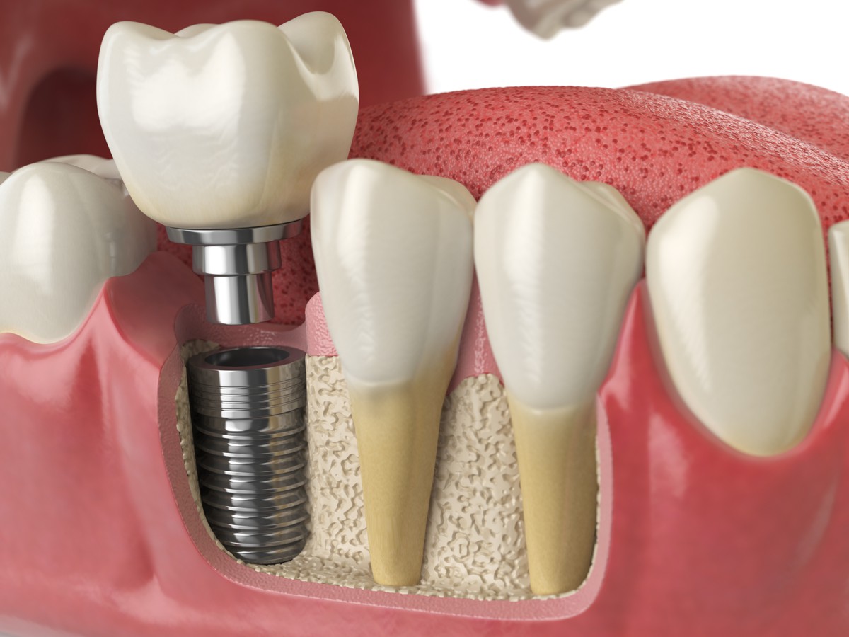 что такое двухэтапная имплантация зубов?