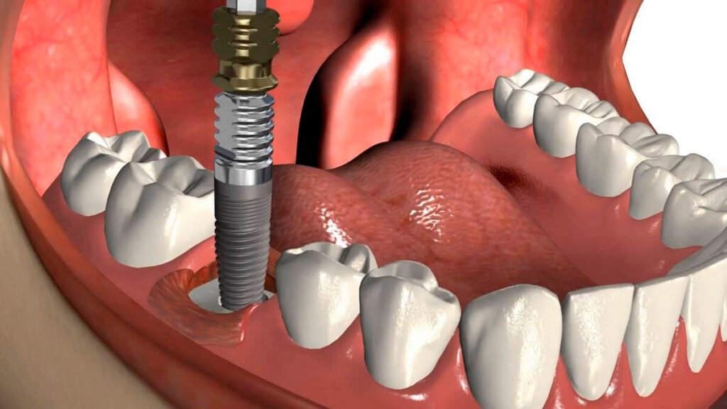 почему могут болеть зубы после имплантации?