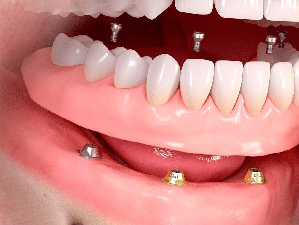 протезирование зубов на 4 имплантах по технологии all-on-4