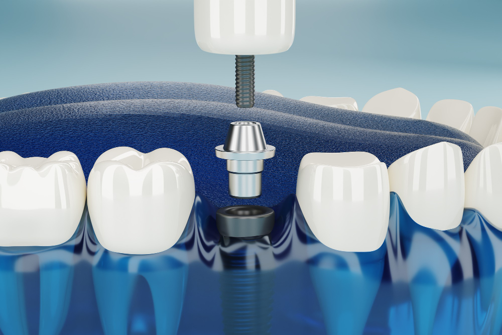что такое одномоментная имплантация зубов?
