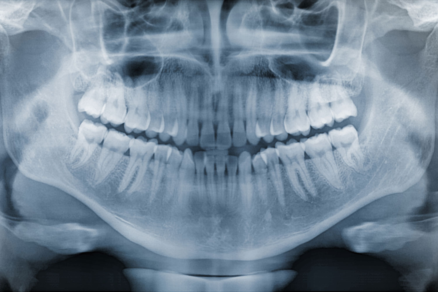 что такое рентген зубов и как его делают?