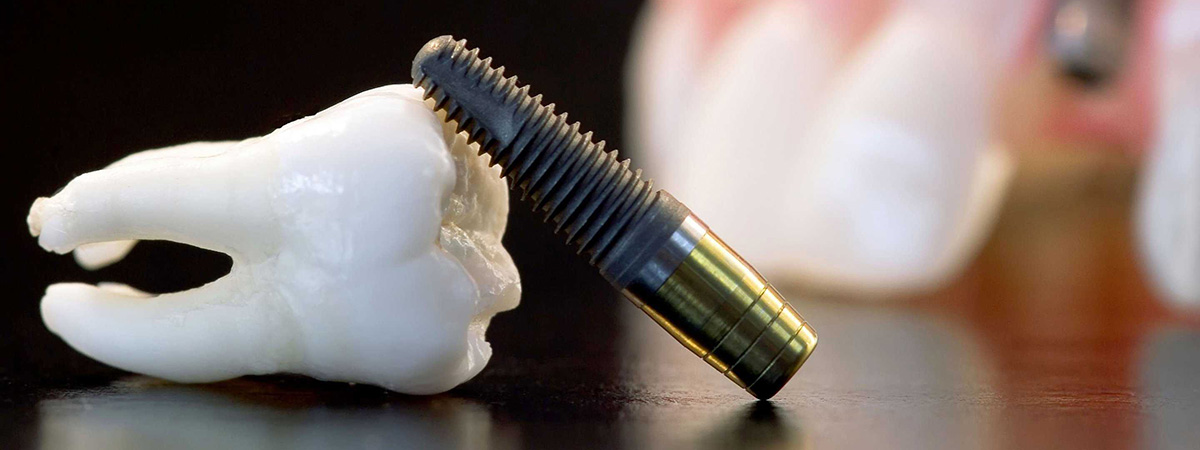 как и когда появилась имплантация зубов?