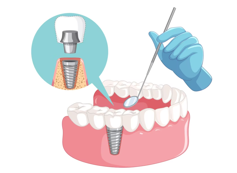осложнения после имплантации зубов. часть 3