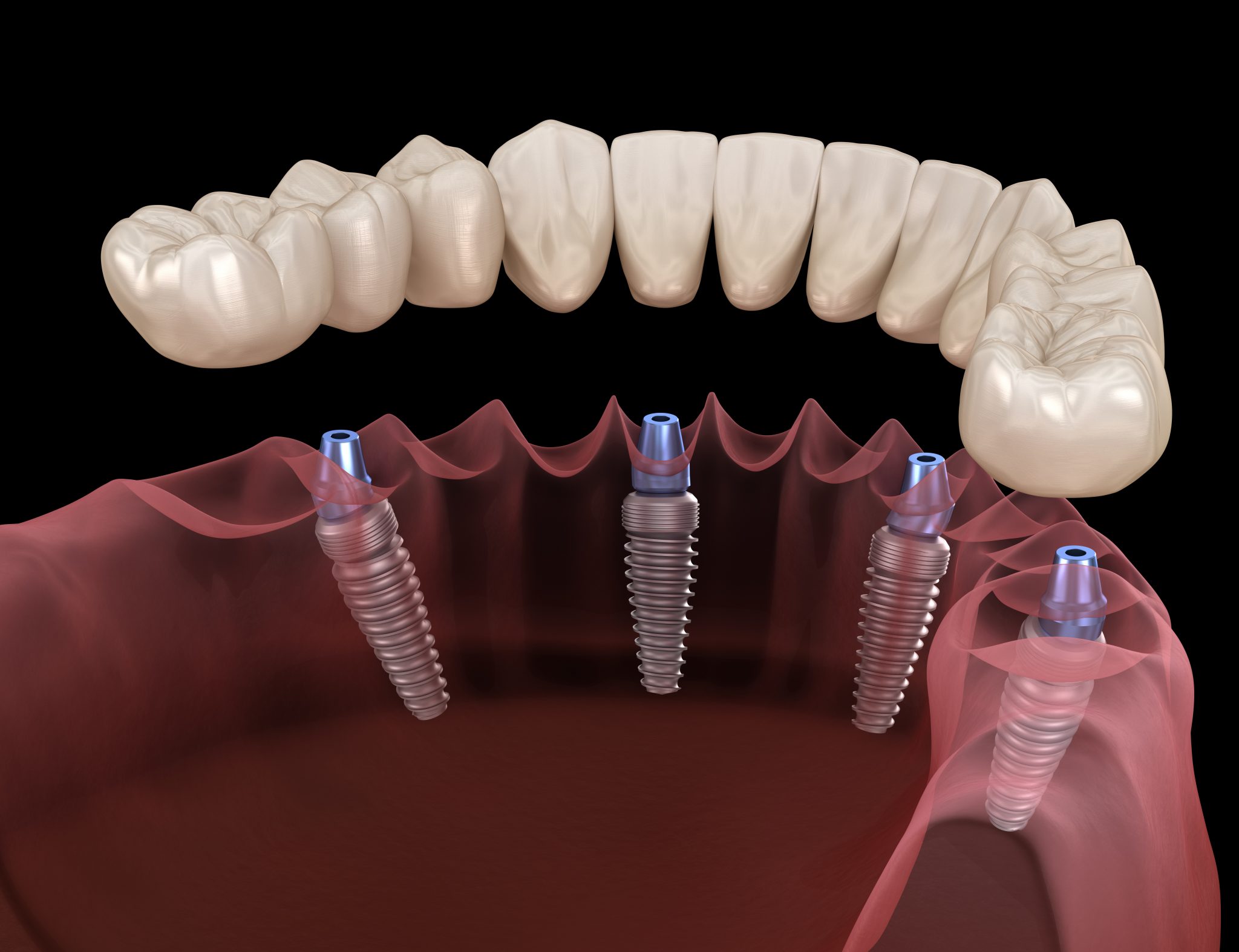 преимущества и недостатки метода имплантации зубов all-on-4