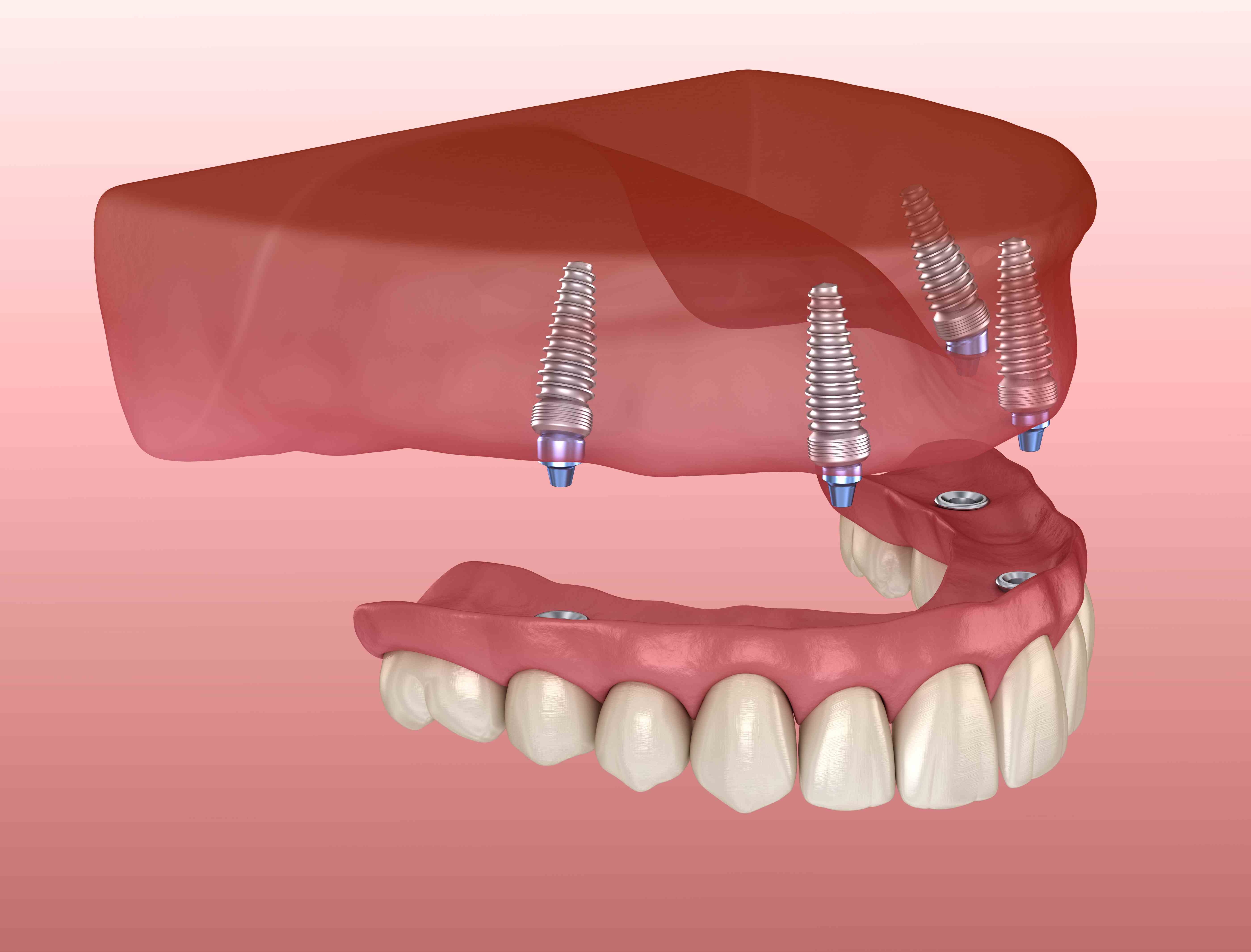 как проводится имплантация зубов и в чем разница между одиночными имплантами и системами all-on-4?