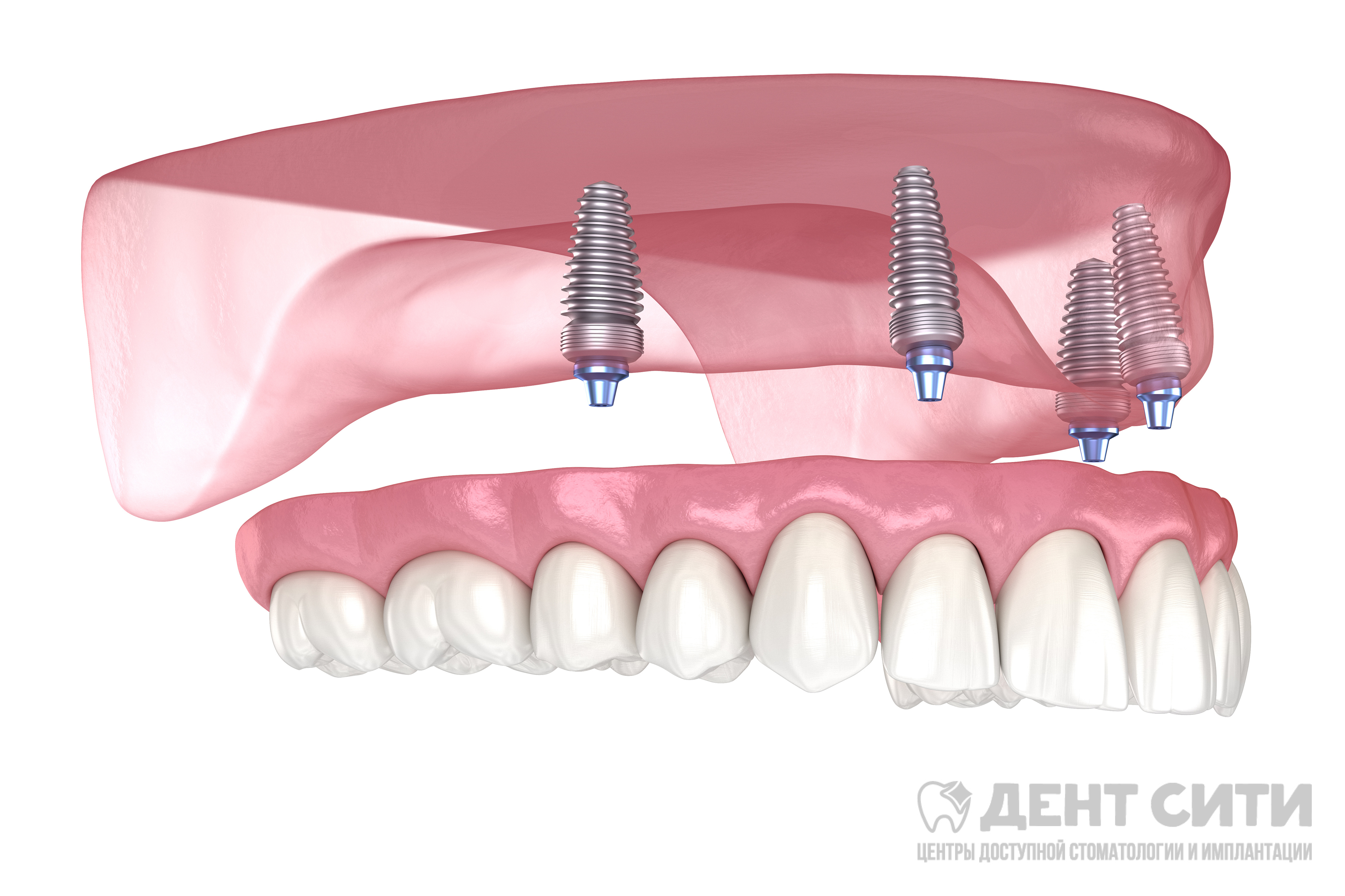 имплантация зубов верхней челюсти