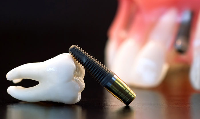ошибки, допускаемые при имплантации зубов