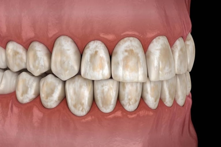 Деминерализация зубной эмали