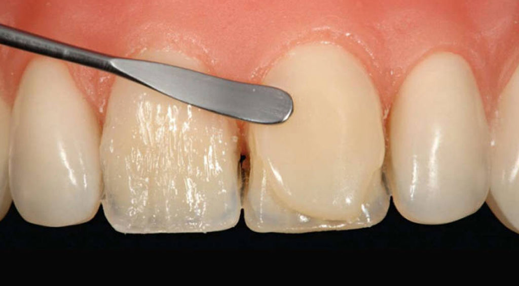 Реставрация зубов композитными материалами