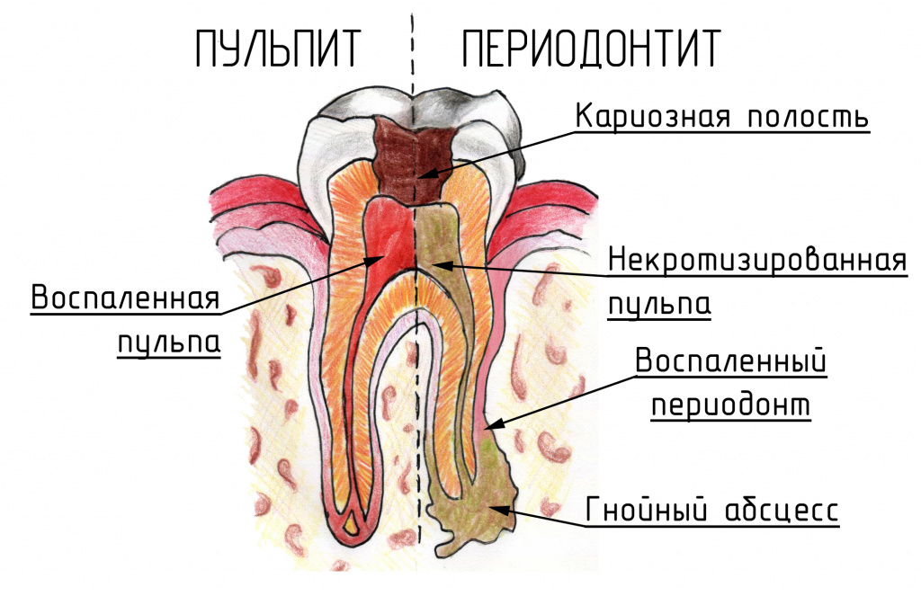 Почему болит зуб?