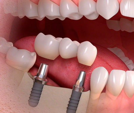 Неподвижные зубные протезы