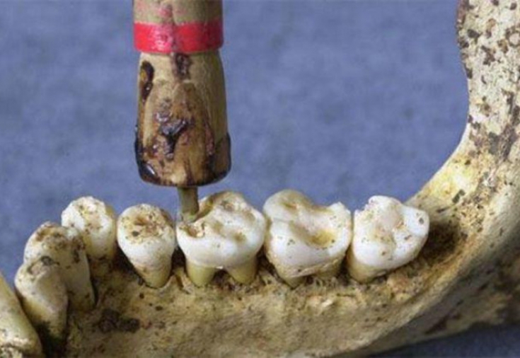 Лечение зубов в древности
