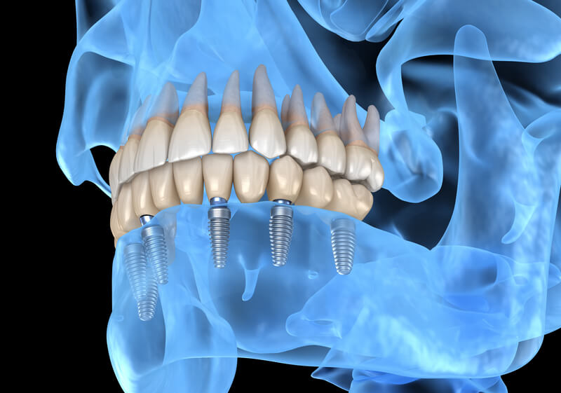 Метод имплантации зубов All-on-6