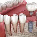 какие противопоказания есть к имплантации зубов?