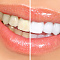 преимущества отбеливания зубов в стоматологической клинике