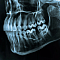 важность компьютерной томографии в планировании установки зубных имплантатов