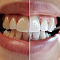 светлее на тон: все о профессиональном отбеливании зубов