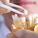 как отличить качественный зубной имплант от некачественного?