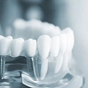 показания к использованию метода имплантации зубов