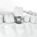 зубные импланты — новейшие технологии и основные тенденции. часть 1