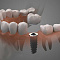зачем нужны зубные импланты?