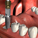 почему могут болеть зубы после имплантации?