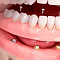 протезирование зубов на 4 имплантах по технологии all-on-4