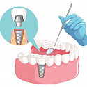 осложнения после имплантации зубов. часть 3