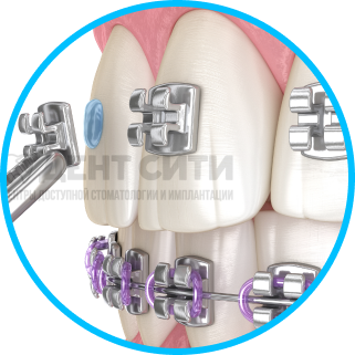 Ортодонтия и брекет-системы