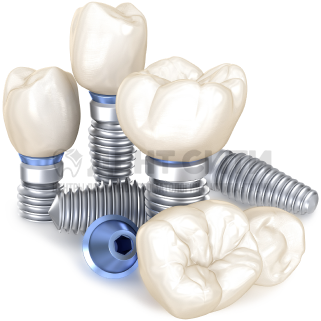 Имплантация зубов и системы All-on- 4, All-on- 5, All-on- 6