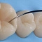 что делать, если выпала зубная пломба?